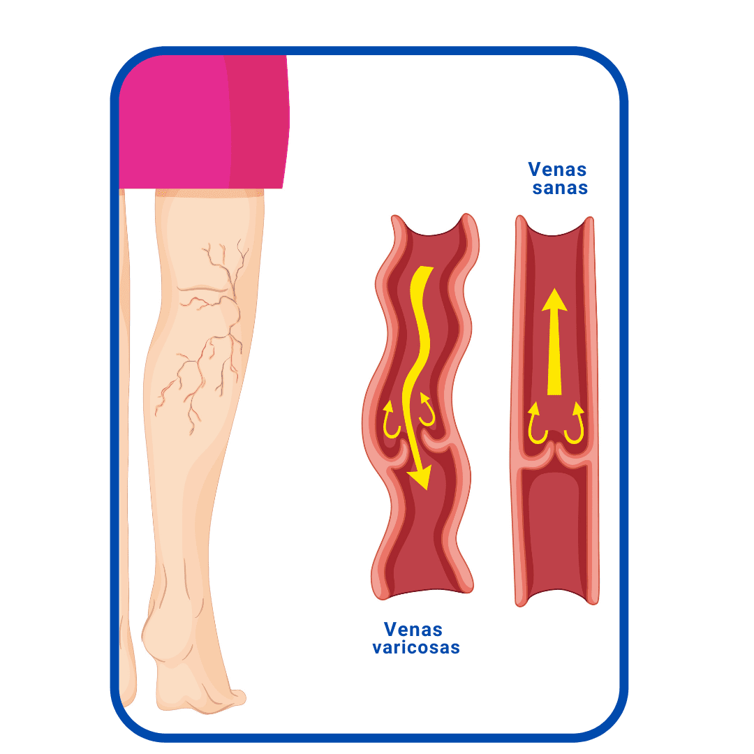 Cómo prevenir las várices en las piernas